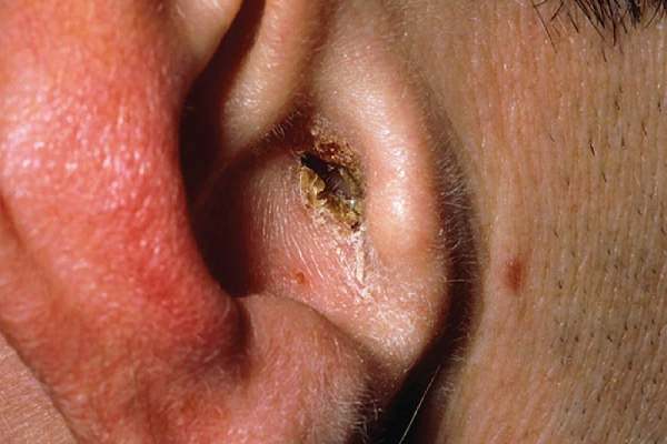 عوامل موثر در بروز قارچ گوش