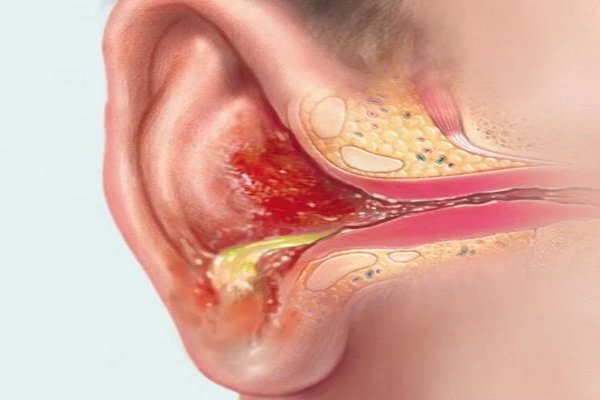 علائم شایع عفونت گوش